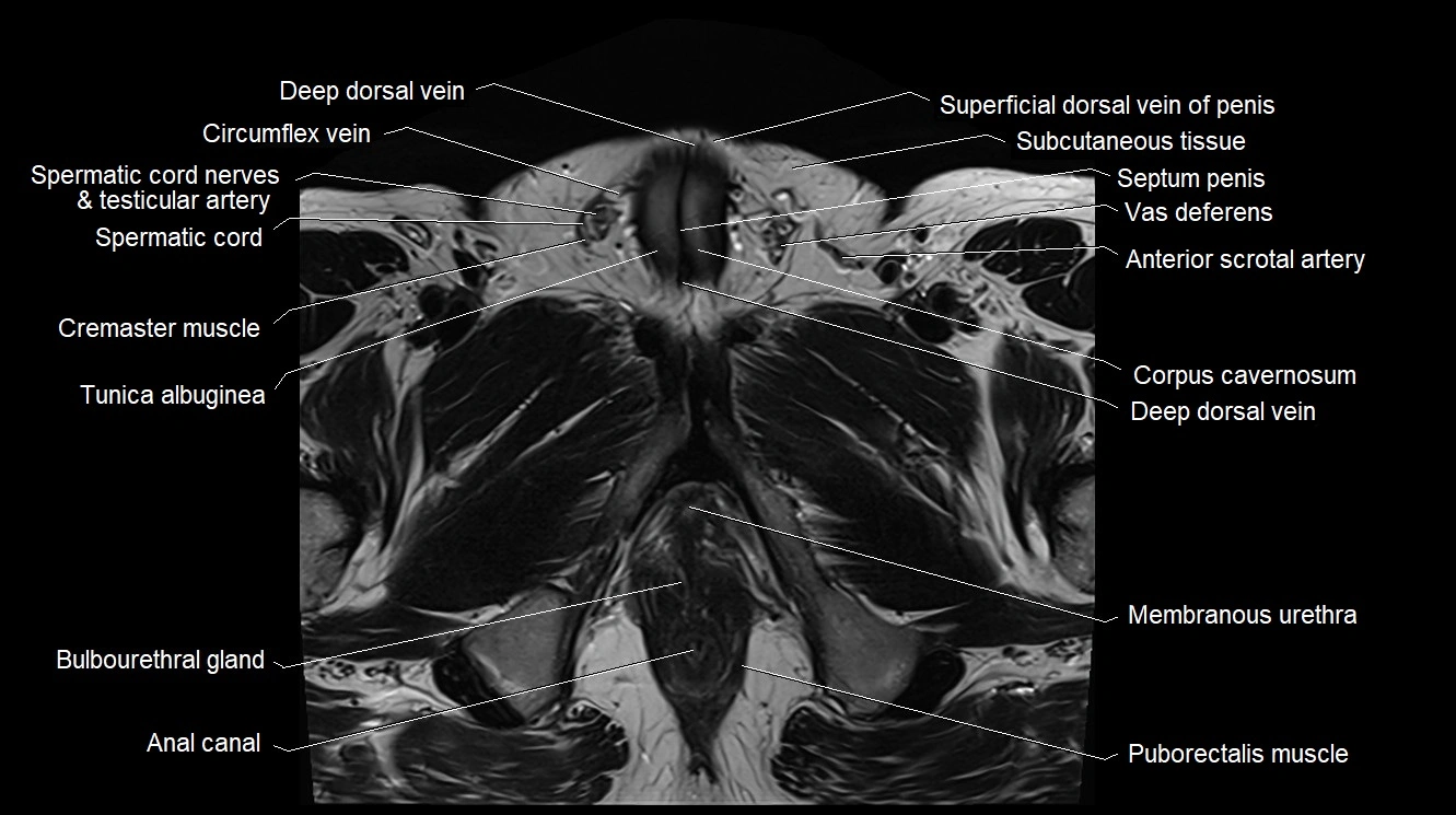 MRI 3T scrotum and penis axial cross sectional anatomy image 15.webp